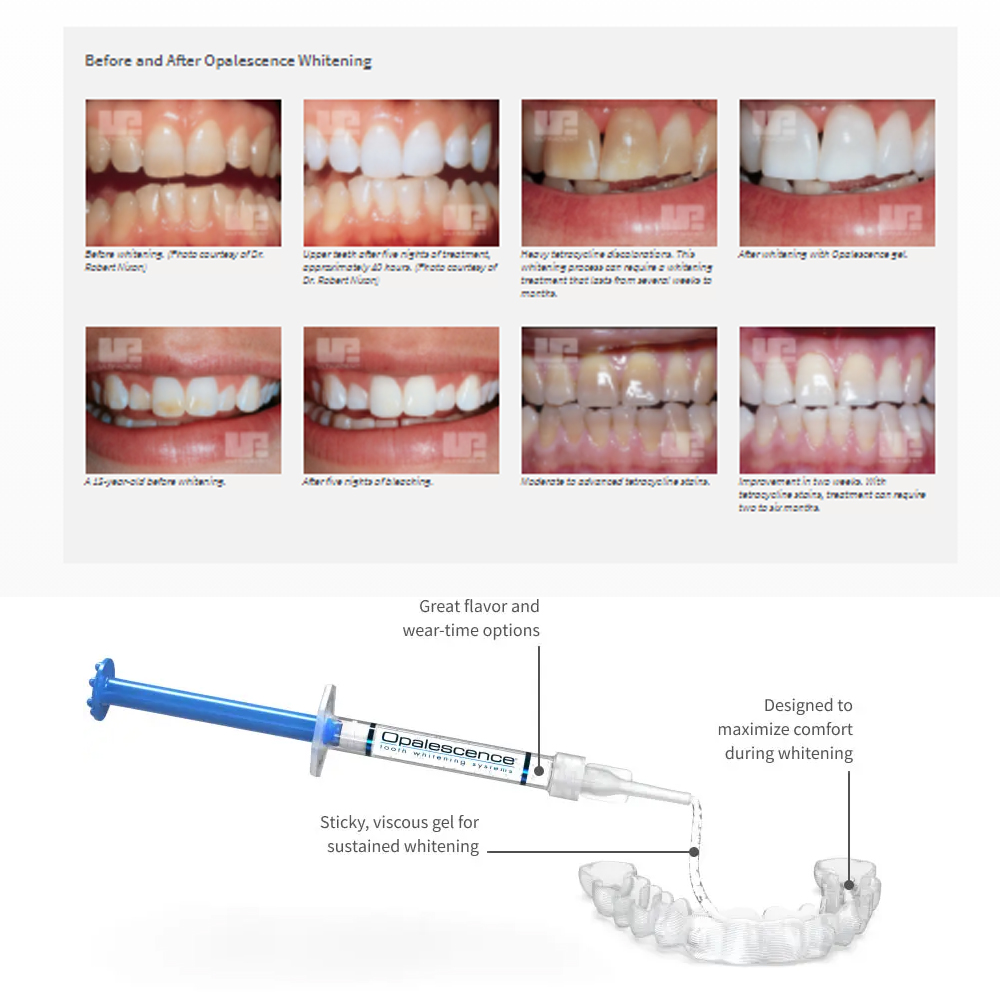 Opalescence Whitening 20% PF 2 - огляд і ціна Teeth Whitening At Home Kit
