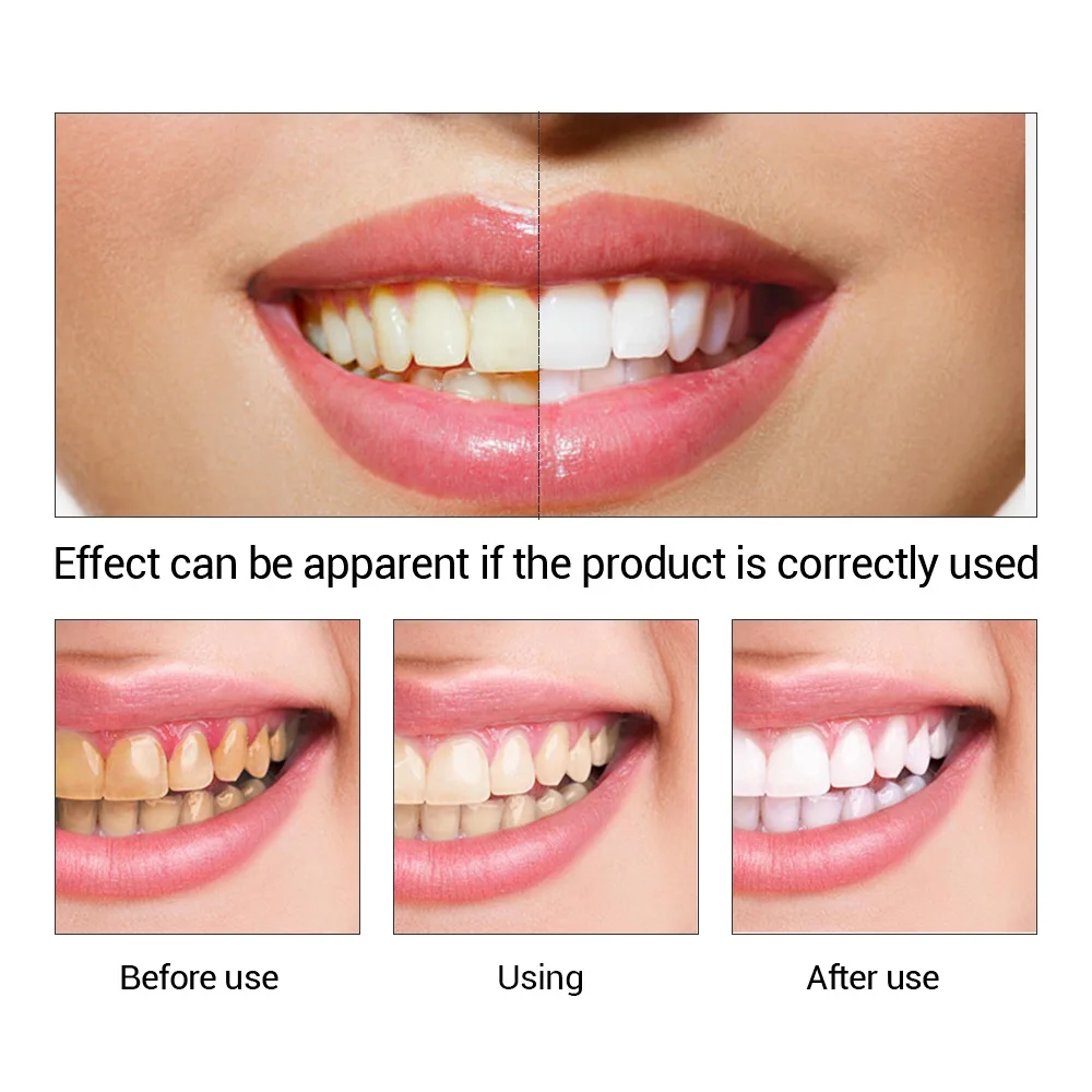FTEENPLY Teeth Whitening Essen - огляд і ціна Teeth Whitening From Home